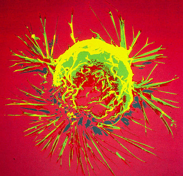  Image from site  cancer cell